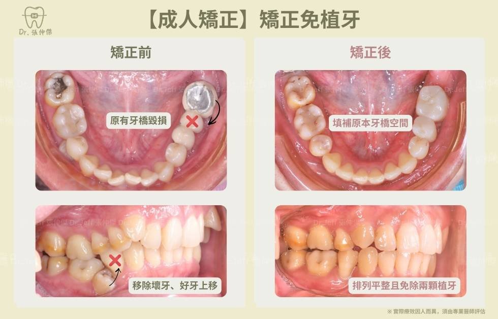 【成人矯正】改善骨暴和笑容牙齦 免植牙 手機