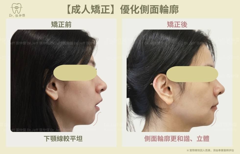 【成人矯正】改善骨暴和笑容牙齦 美觀線 (2) 手機