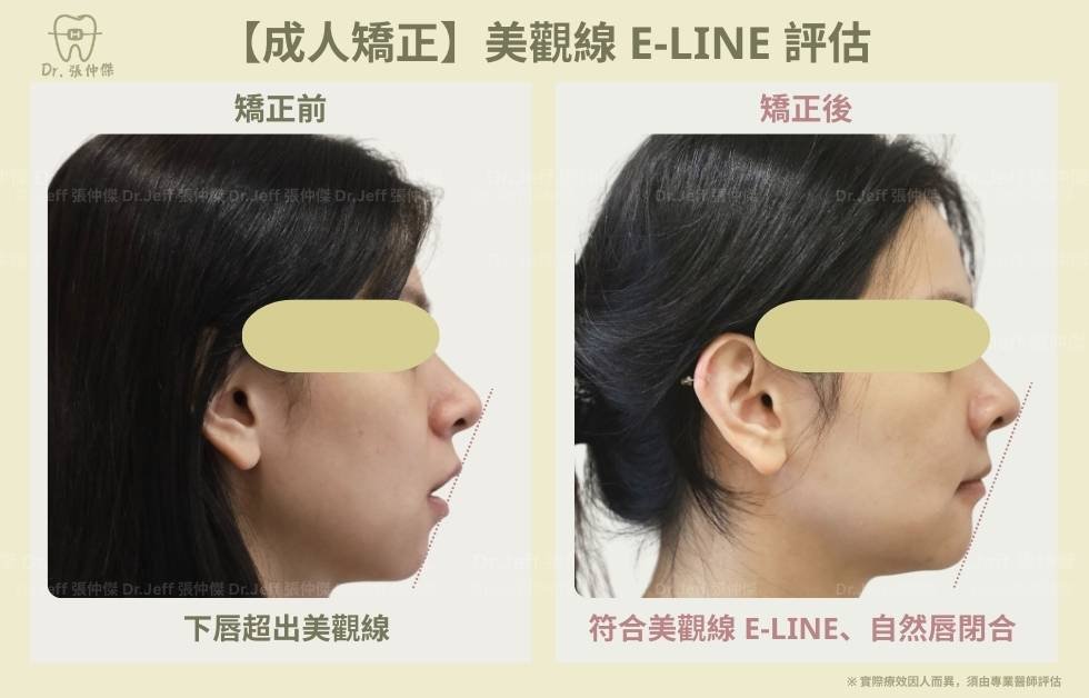 【成人矯正】改善骨暴和笑容牙齦 美觀線評估