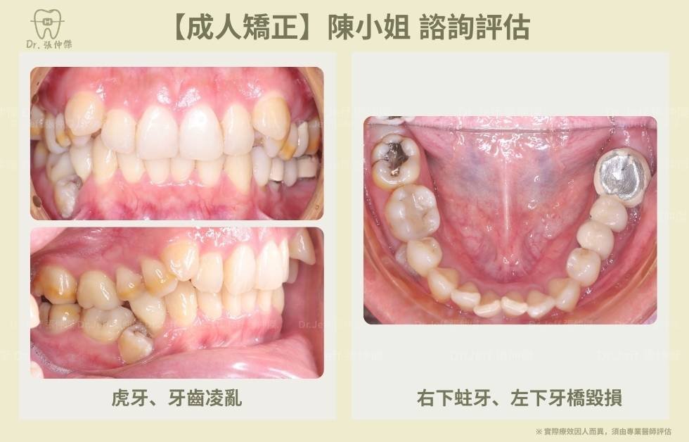 【成人矯正】改善骨暴和笑容牙齦 蛀牙 齒亂 牙橋毀損 手機