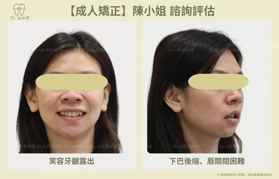 【成人矯正】改善骨暴和笑容牙齦 諮詢評估 手機