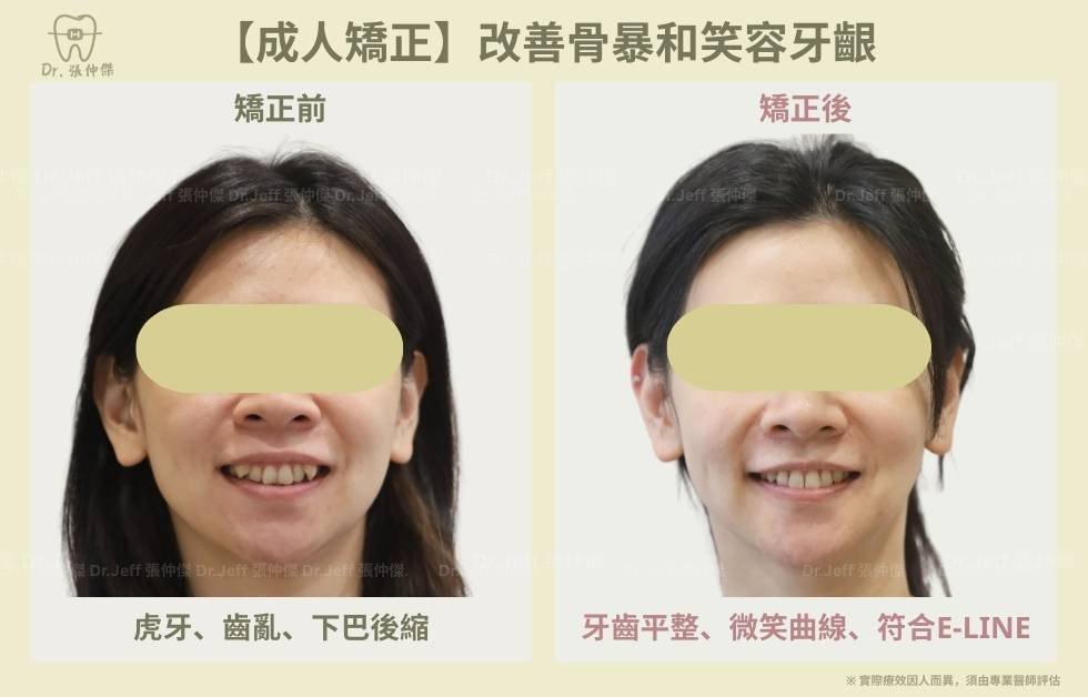 【成人矯正】改善骨暴和笑容牙齦 手機