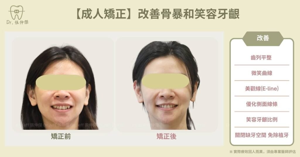 【成人矯正】改善骨暴和笑容牙齦＿:封面
