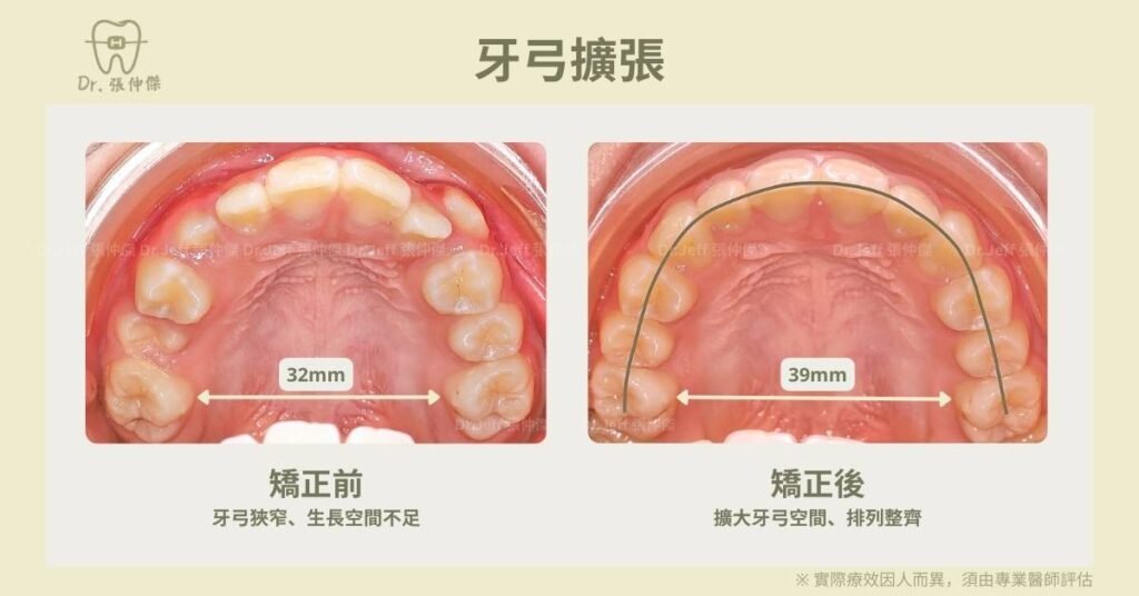 兒童矯正案例1 擴大牙弓