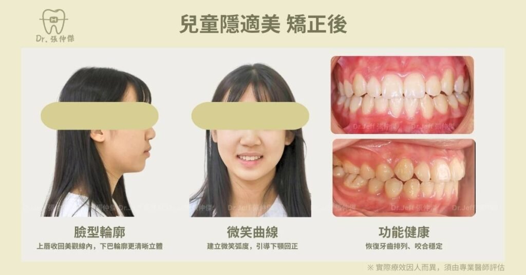 兒童矯正案例1虎牙、門牙歪、擴大牙弓-3