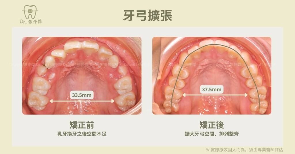 兒童矯正案例2擴大牙弓