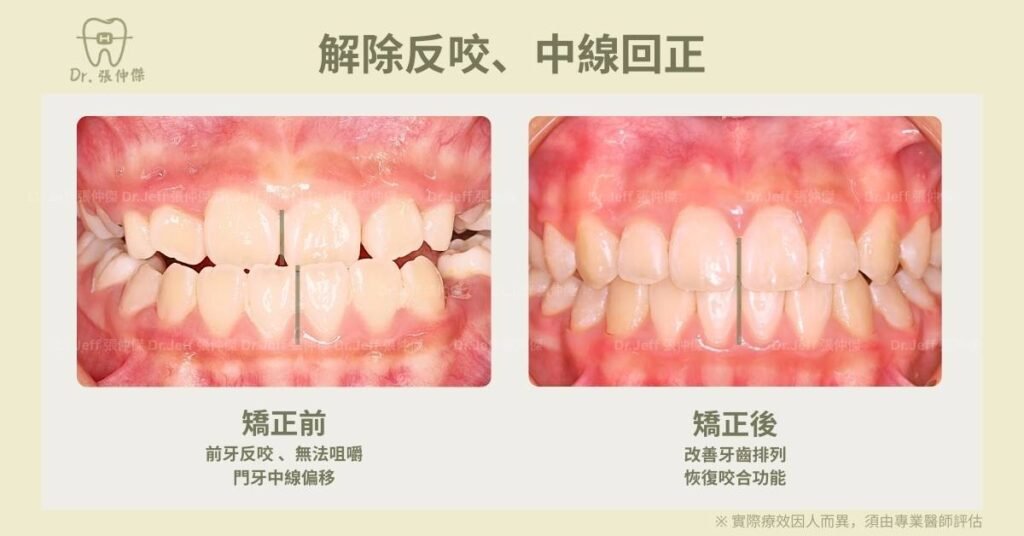 兒童矯正案例2門牙歪