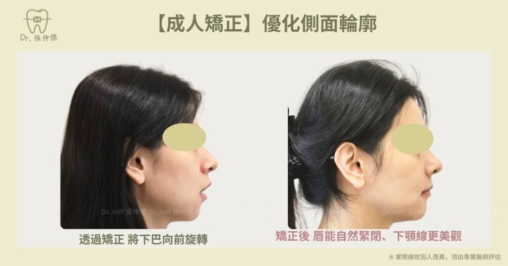 成人一【成人矯正】優化側面輪廓