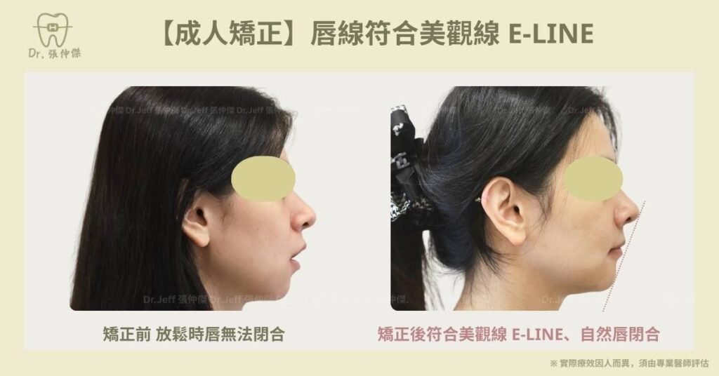 成人一【成人矯正】唇線符合美觀線 e line