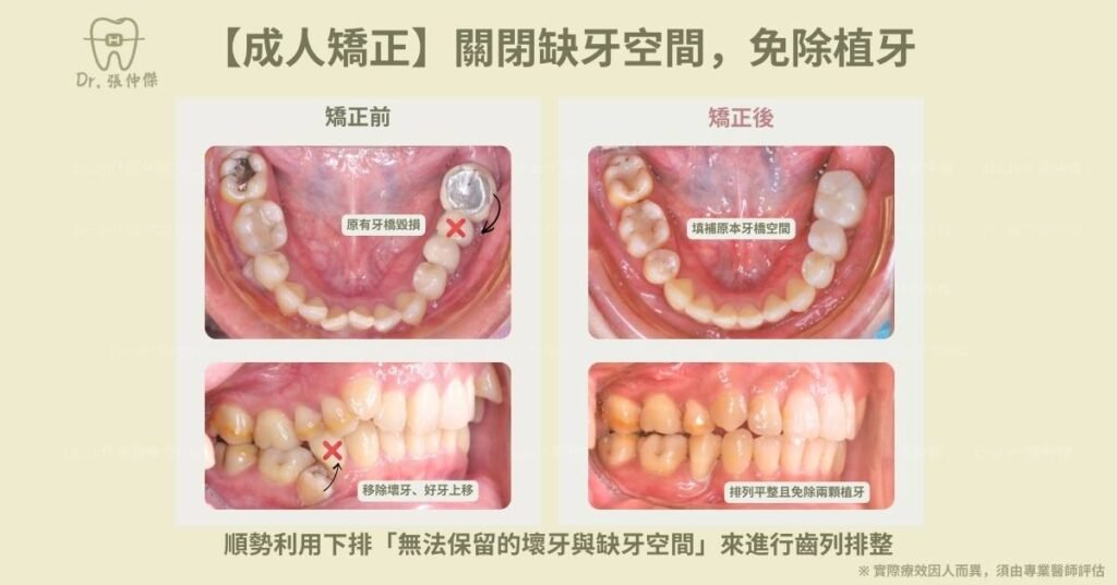 成人一【成人矯正】關閉缺牙空間，免除植牙