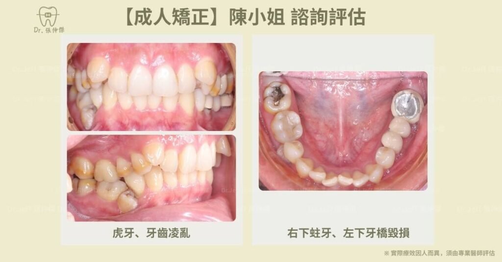 成人一【成人矯正】陳小姐 諮詢評估 口內
