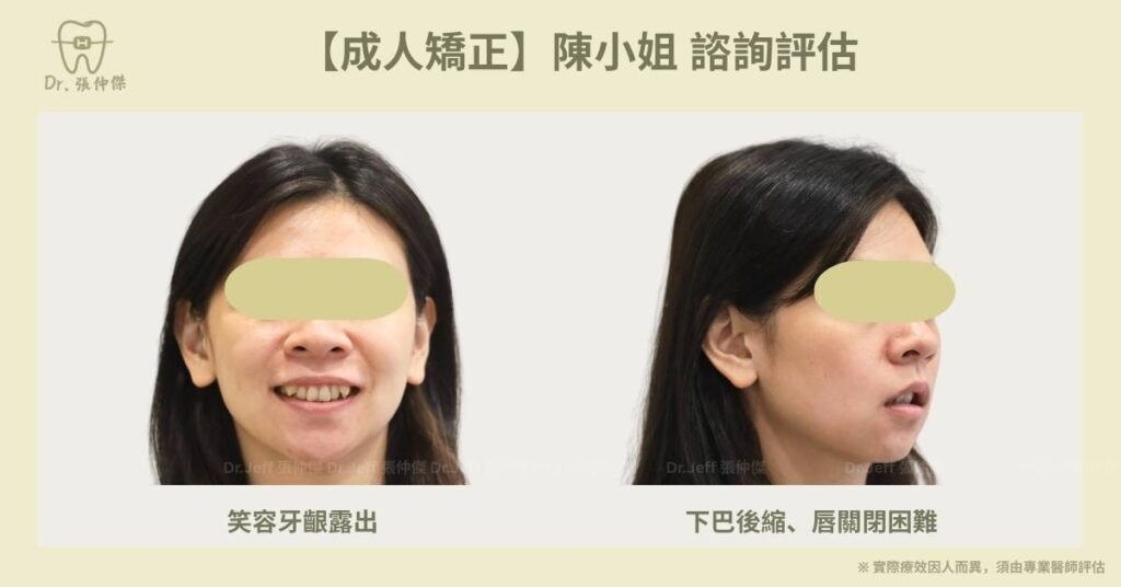 成人一【成人矯正】陳小姐 諮詢評估 外觀