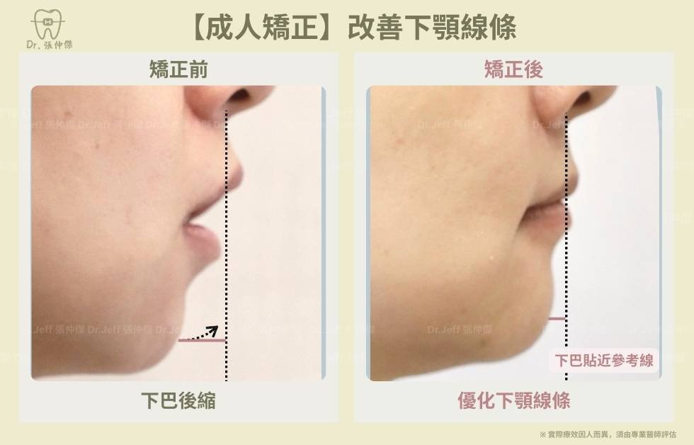 成人一＿下顎線調整【成人矯正】改善骨暴和笑容牙齦 下顎線