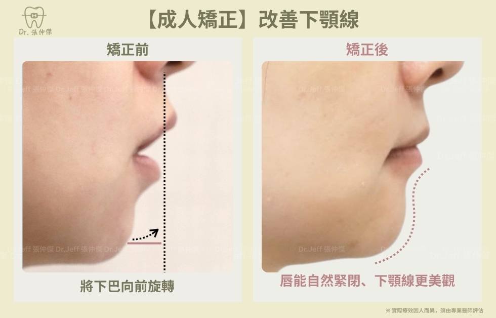 成人一＿下顎線調整【成人矯正】改善骨暴和笑容牙齦 美觀下顎線