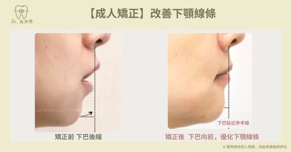 成人一＿下顎線調整【成人矯正】重塑下顎線條
