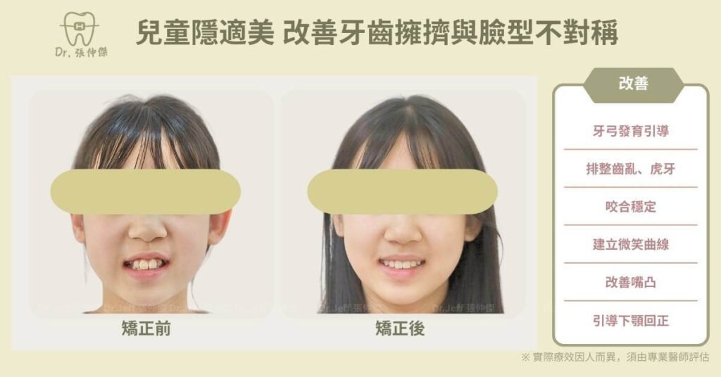 首頁 | 牙齒矯正 為什麼找張仲傑牙醫師 案例1 1