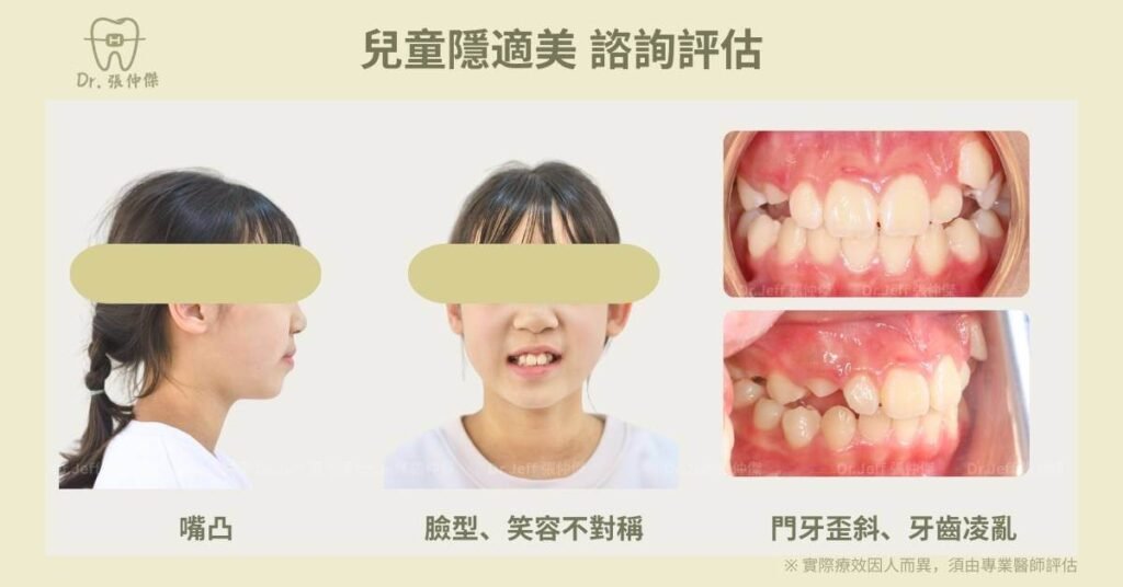 兒童隱適美 改善牙齒擁擠與臉型不對稱，矯正前的照片
