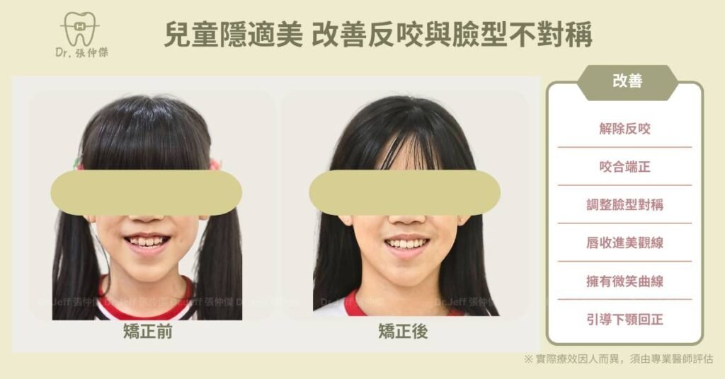 【兒童隱適美牙齒矯正】 把握黃金期引導生長，改善反咬與臉型對稱｜張仲傑醫師