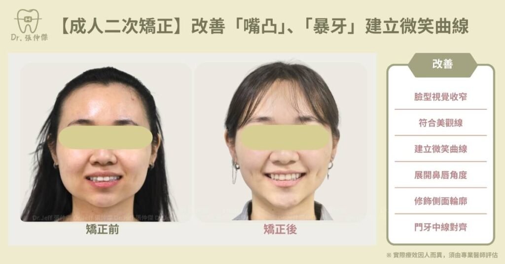 【成人二次矯正】改善「嘴凸」、「暴牙」建立微笑曲線