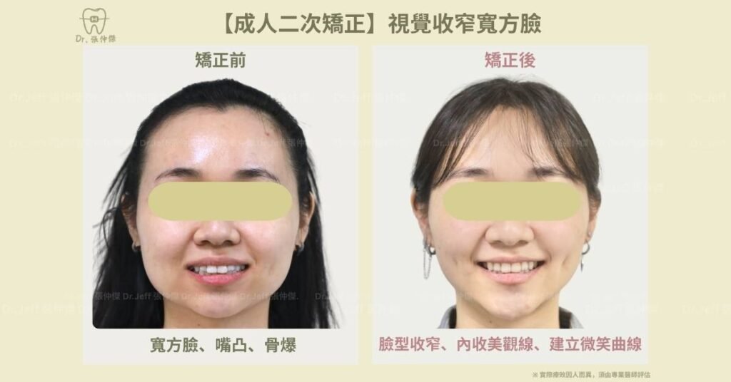 【成人二次矯正】視覺收窄寬方臉