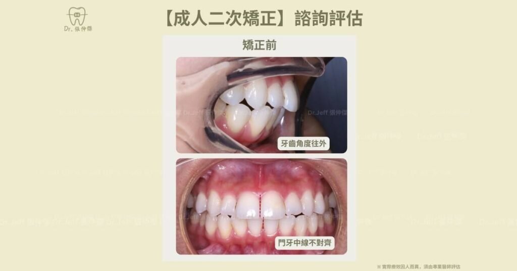 【成人二次矯正】諮詢評估 牙齒角度