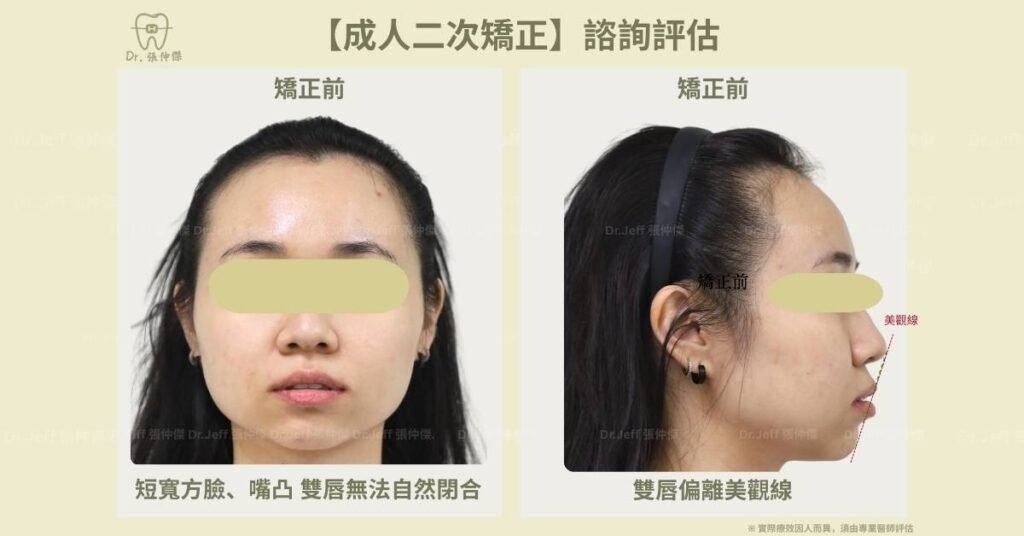【成人二次矯正】諮詢評估 美觀線