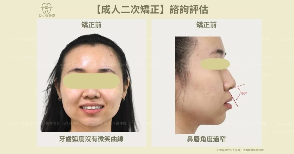 【成人二次矯正】諮詢評估 鼻唇角度