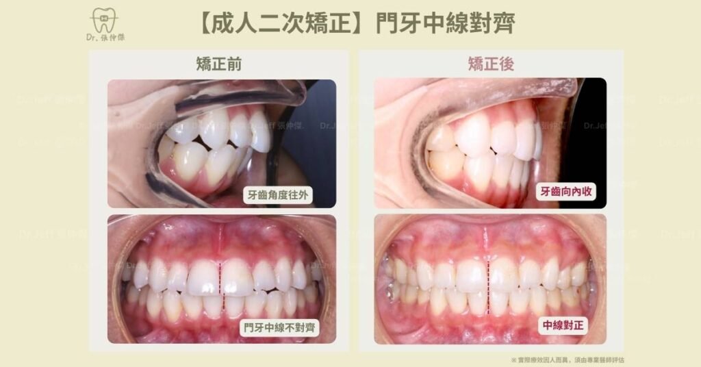 【成人二次矯正】門牙中線對齊
