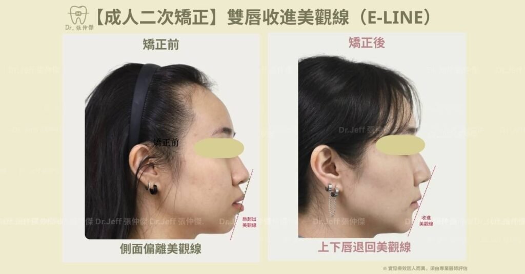 【成人二次矯正】雙唇收進美觀線（e line）