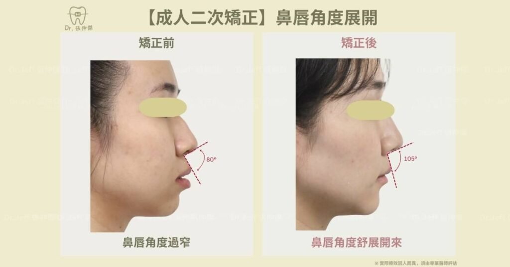 【成人二次矯正】鼻唇角度展開