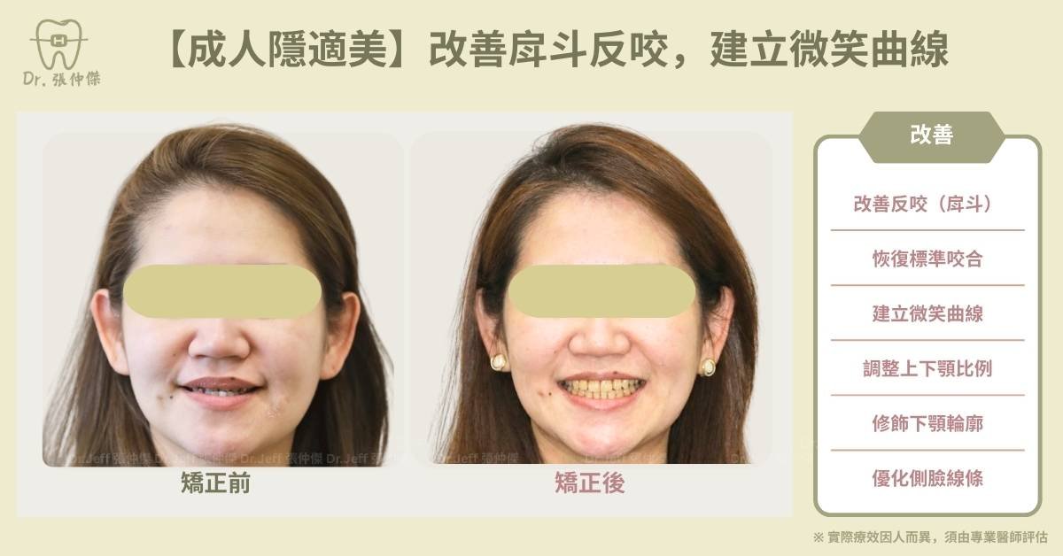 【成人隱適美】不開刀改善「戽斗」、解除「反咬」，建立微笑曲線