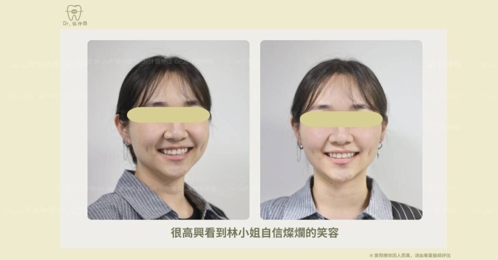 成人案例三 很高興看到林小姐自信燦爛的笑容