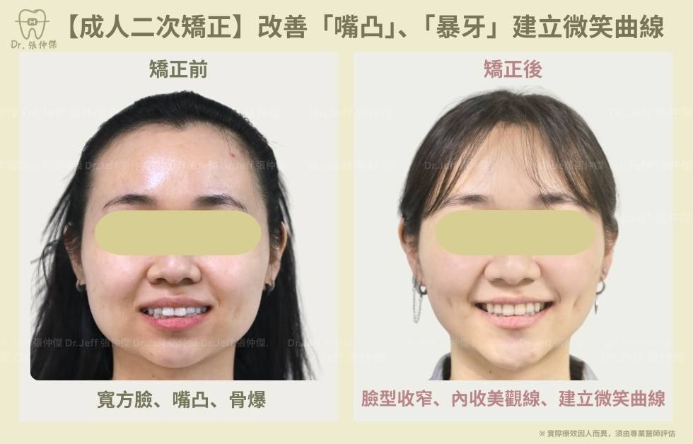 手機 【成人二次矯正】改善「嘴凸」、「暴牙」建立微笑曲線