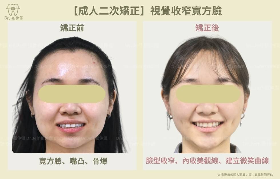 手機 【成人二次矯正】視覺收窄寬方臉