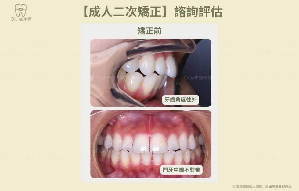 手機 【成人二次矯正】諮詢評估 牙齒角度