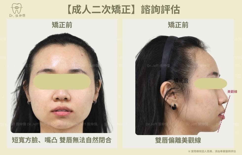 手機 【成人二次矯正】諮詢評估 美觀線