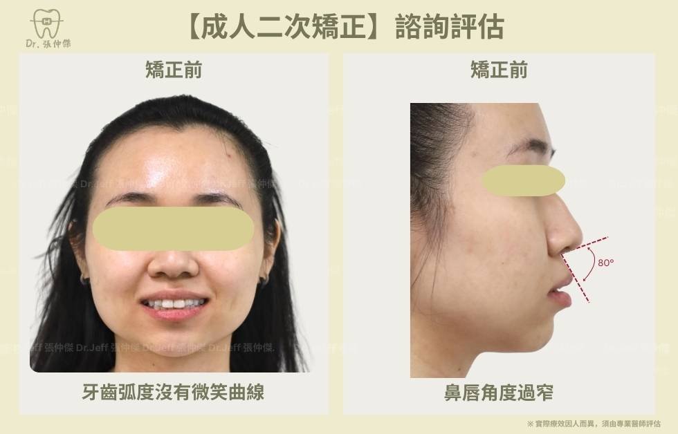 手機 【成人二次矯正】諮詢評估 鼻唇角度