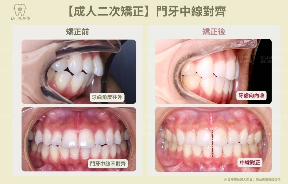 手機 【成人二次矯正】門牙中線對齊