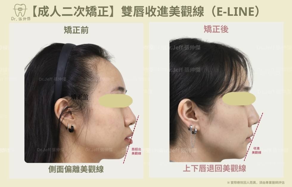手機 【成人二次矯正】雙唇收進美觀線（e line）