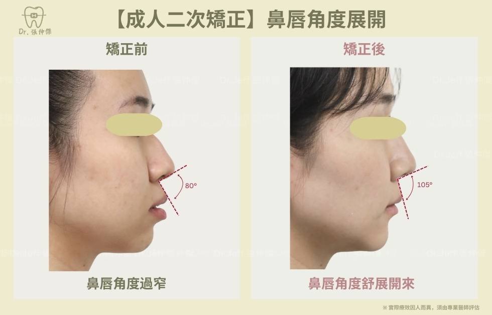 手機 【成人二次矯正】鼻唇角度展開