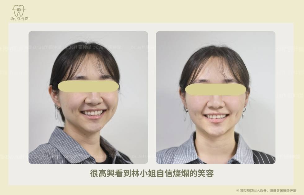 手機 成人案例三 很高興看到林小姐自信燦爛的笑容