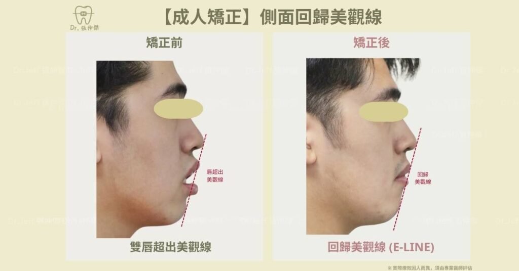 【成人矯正】側面回歸美觀線