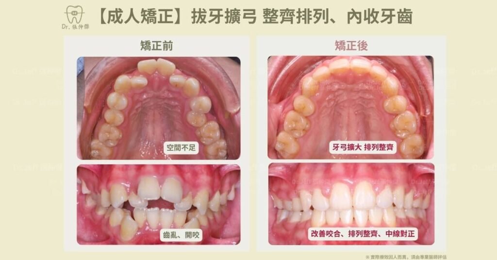 【成人矯正】拔牙擴弓 整齊排列、內收牙齒