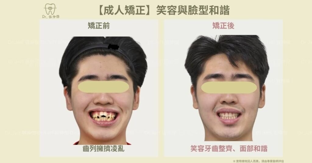 【成人矯正】笑容與臉型和諧