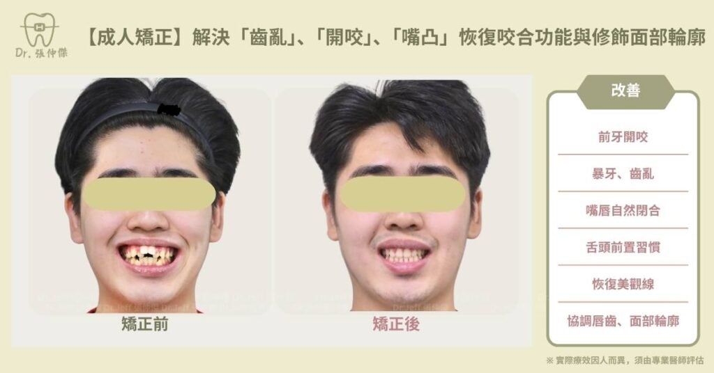 【成人矯正】解決「齒亂」、「開咬」、「嘴凸」恢復咬合功能與修飾面部輪廓
