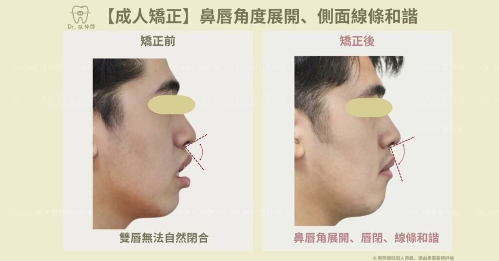 【成人矯正】鼻唇角度展開、側面線條和諧