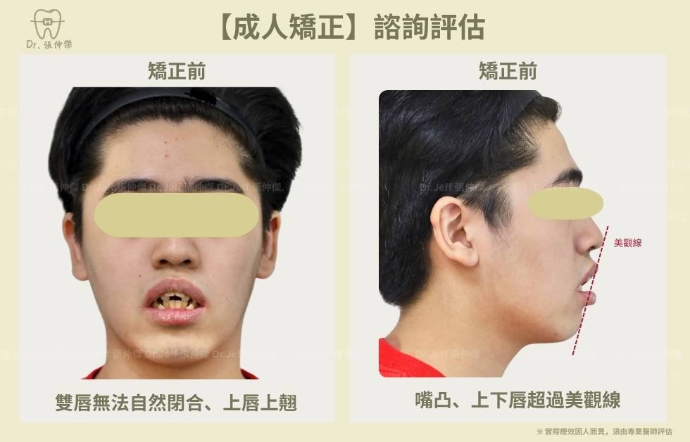 手機 4 1【成人矯正】諮詢評估