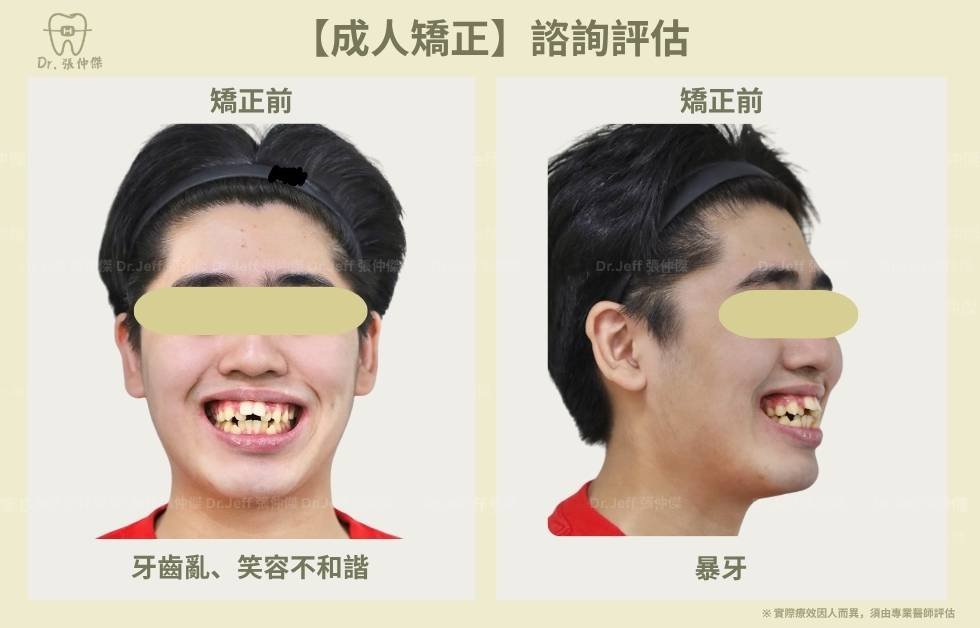手機 4 2【成人矯正】諮詢評估