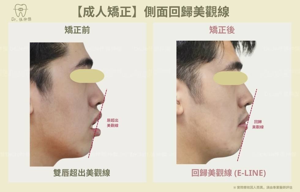 手機 【成人矯正】側面回歸美觀線