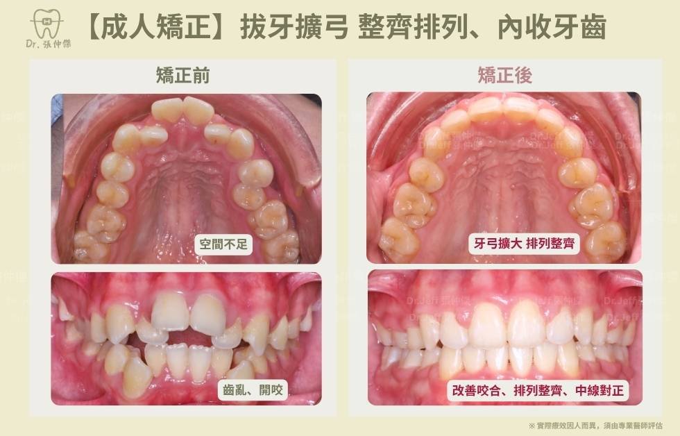 手機 【成人矯正】拔牙擴弓 整齊排列、內收牙齒